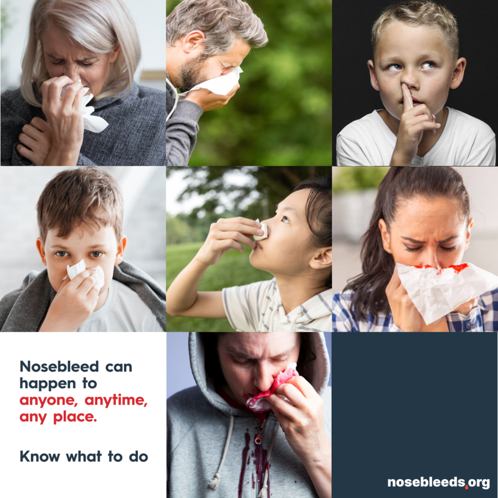 Nosebleed can happen to anyone, anytime, any place.